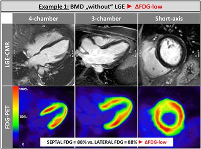 Hybrid CMR- and FDG-PET-Imaging Gives New Insights Into the Relationship of Myocardial Metabolic Activity and Fibrosis in Patients With Becker Muscular Dystrophy